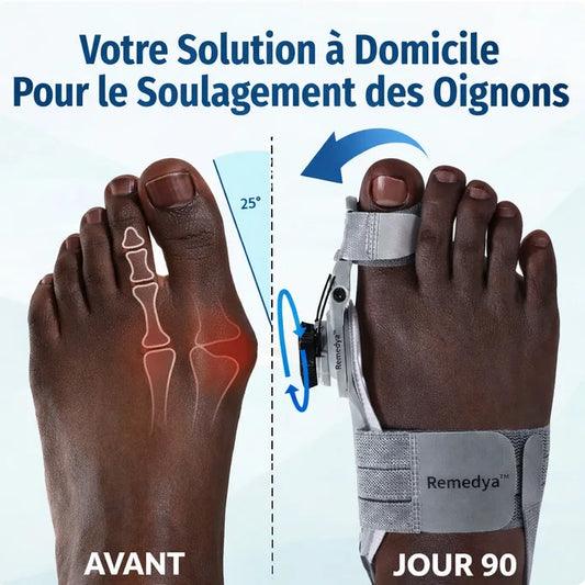 Remedya™: Correcteur Orthopédique pour oignons